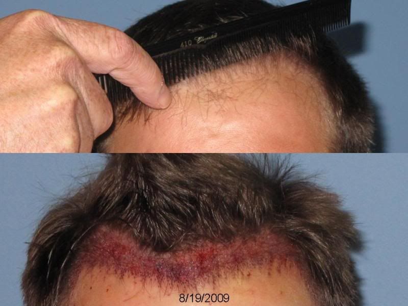 finasteride before and after. finasteride before and after.